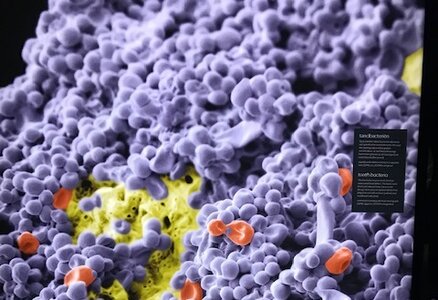 Přednáška - Mikrobiom a solidní nádory